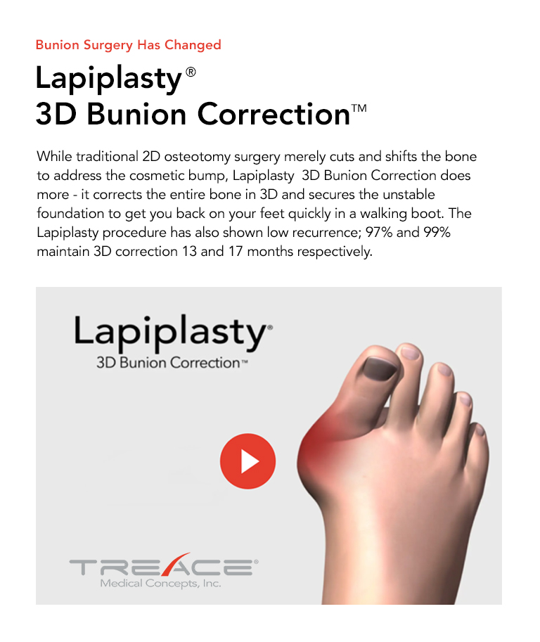 Lapiplasty 3D Bunion Correction treatment at Family Footcare Connecticut